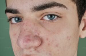 Bruntusan karena purging wajah